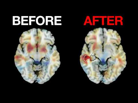 Electroconvulsive Therapy's Role in Treating Depression